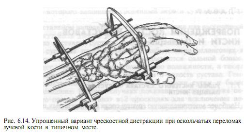 Как вставляют спицы при переломе